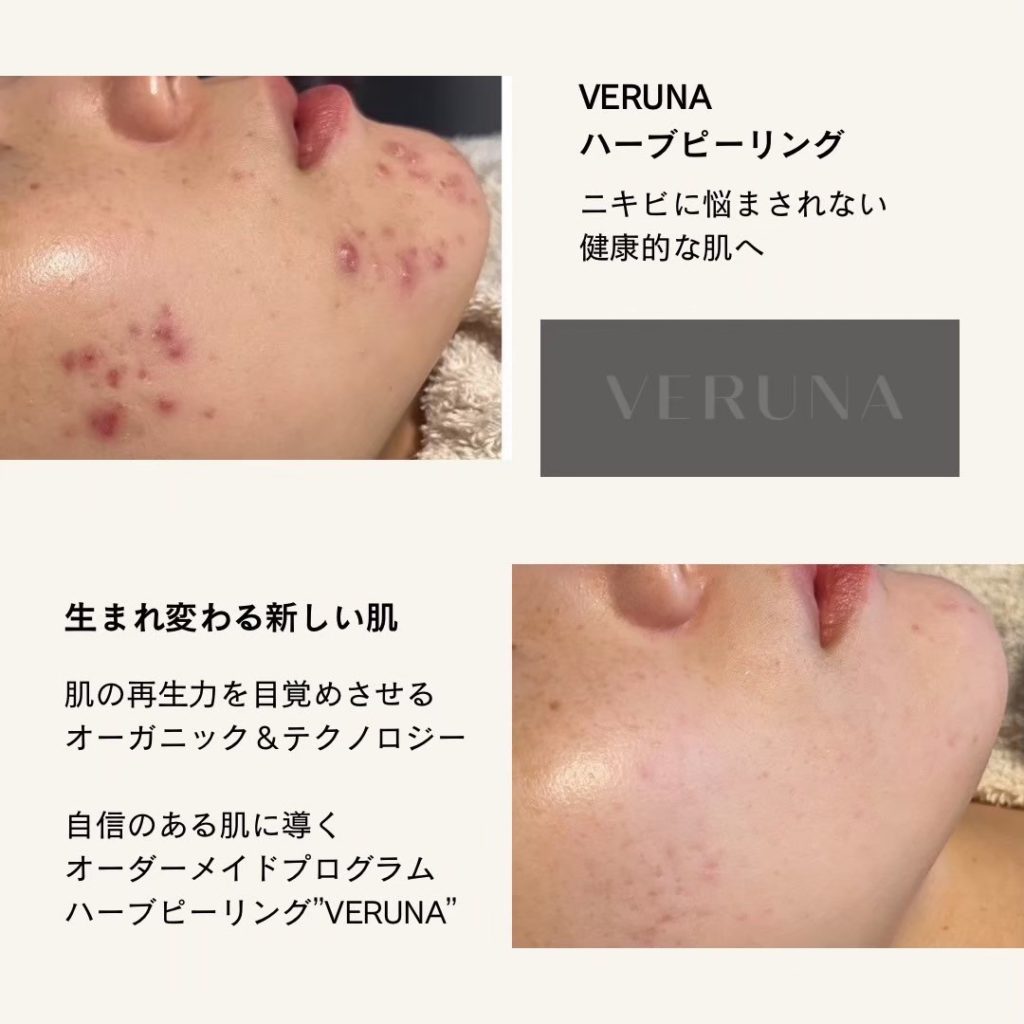 ハーブピーリング