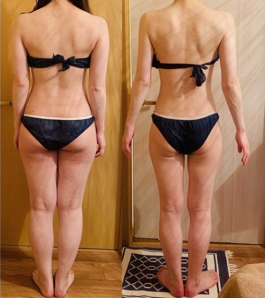 ブライダル痩身